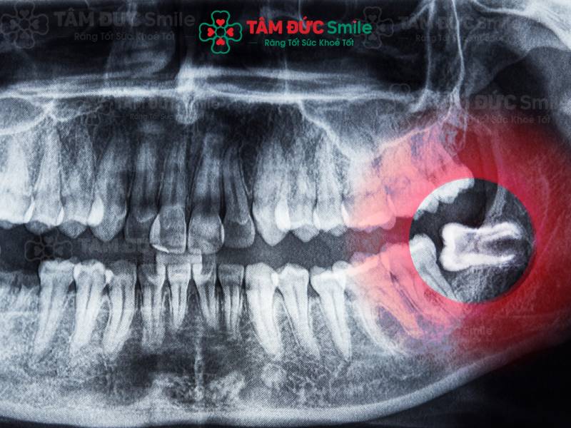 Tại sao nhổ răng khôn phải xét nghiệm máu