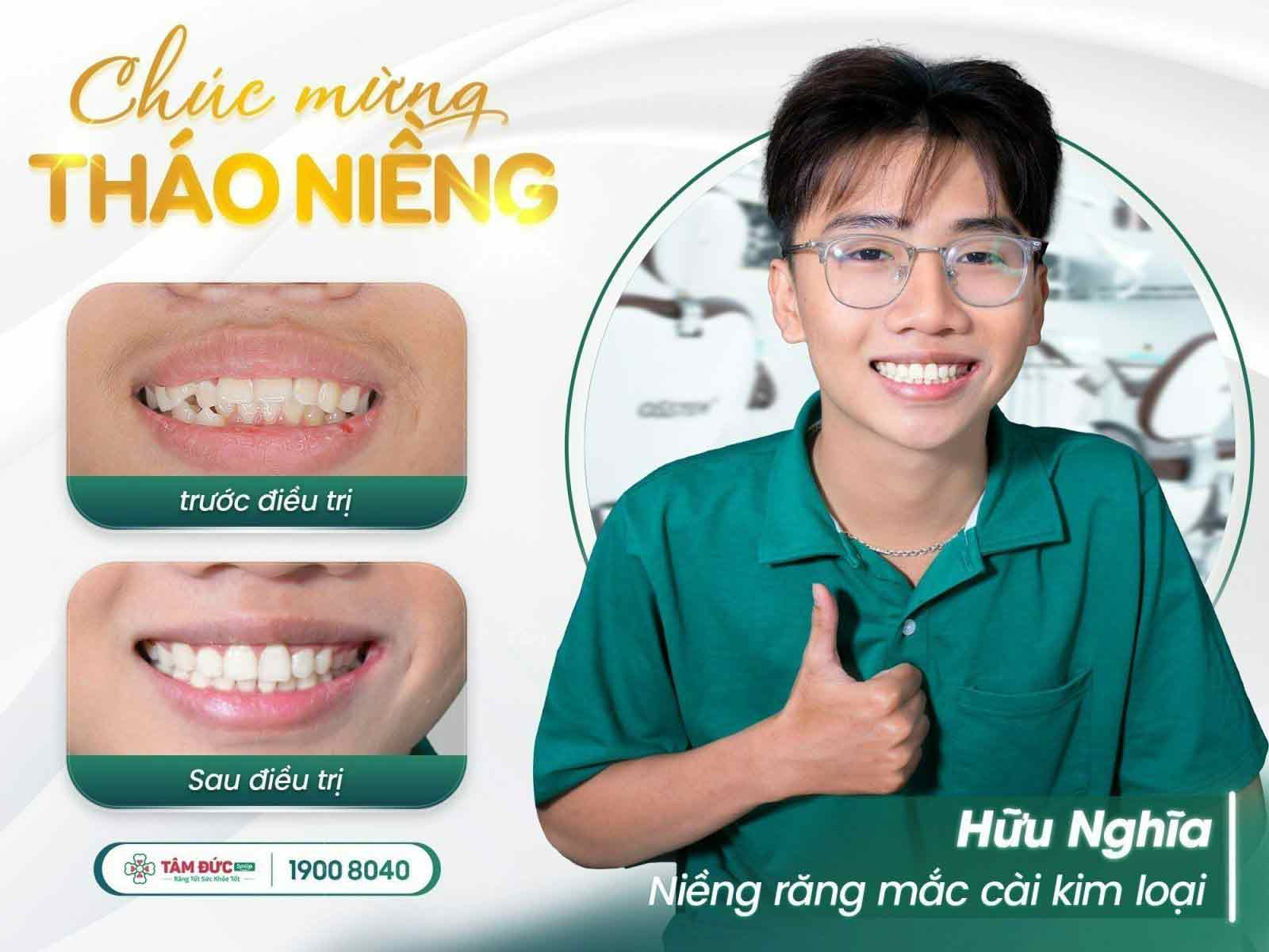 tại sao răng mọc lệch