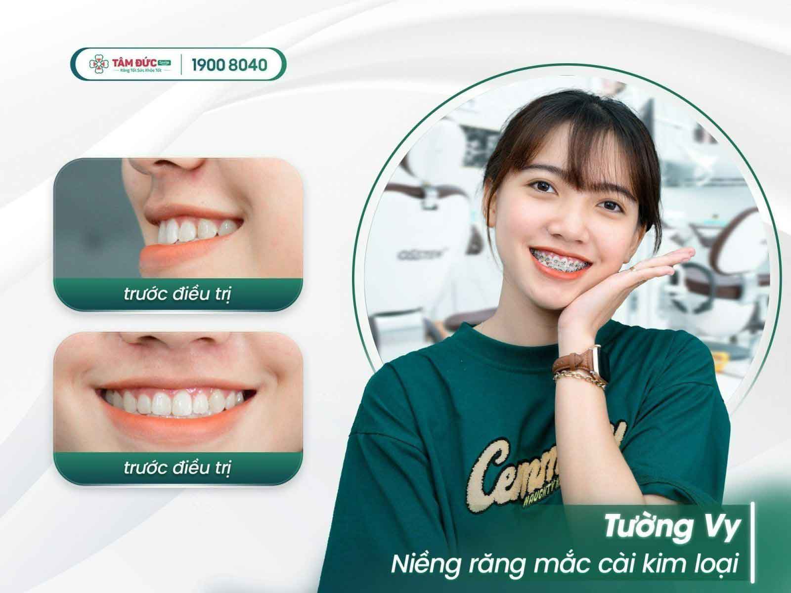 răng mọc lệch là do đâu