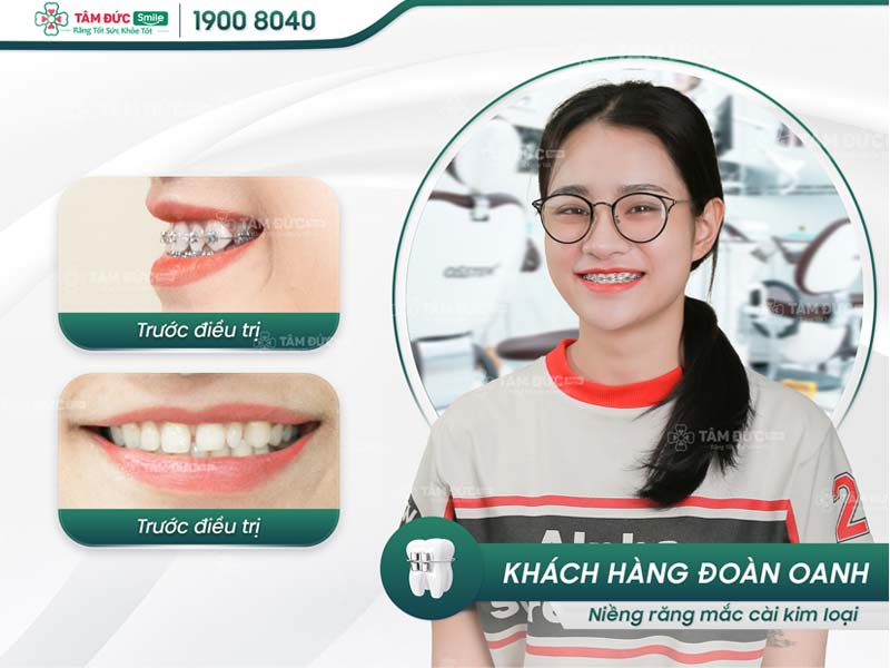 khách hàng niềng răng tại nha khoa Tâm Đức Smile Cần Thơ