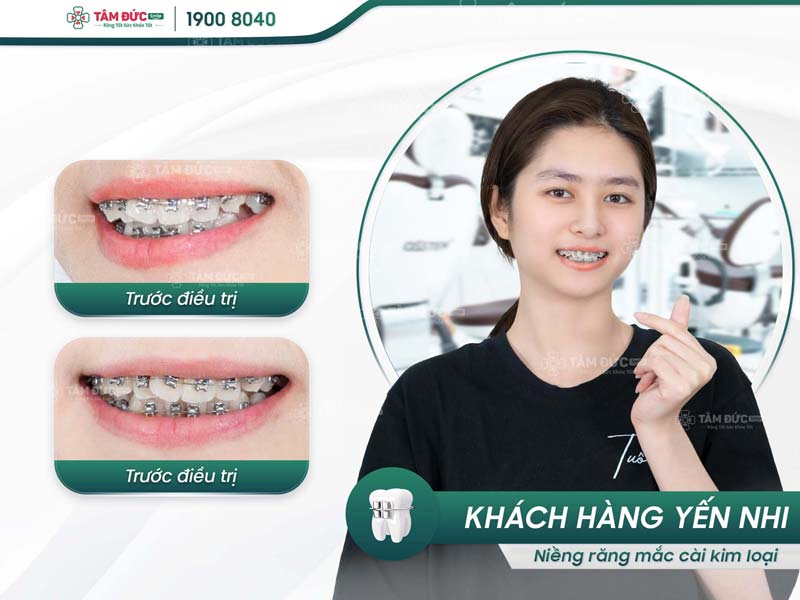 khách hàng niềng răng tại nha khoa Tâm Đức Smile Cần Thơ