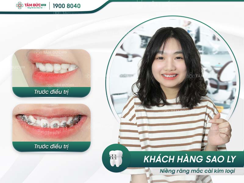 khách hàng niềng răng tại nha khoa Tâm Đức Smile Cần Thơ