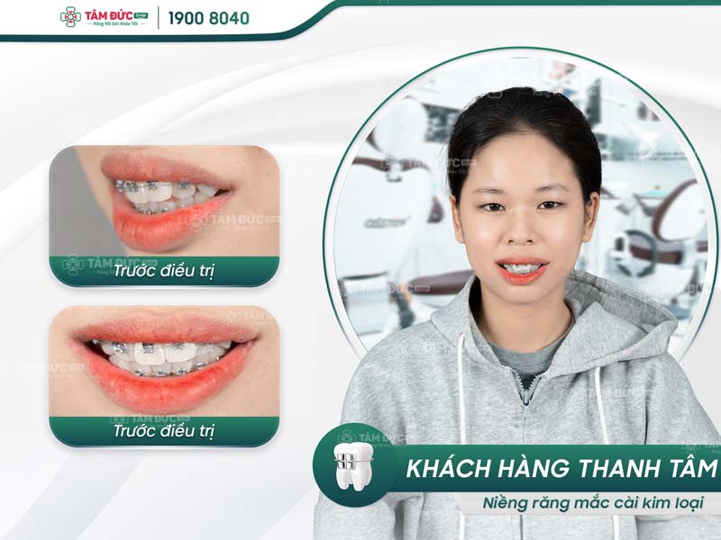 khách hàng niềng răng tại nha khoa Tâm Đức Smile Cần Thơ