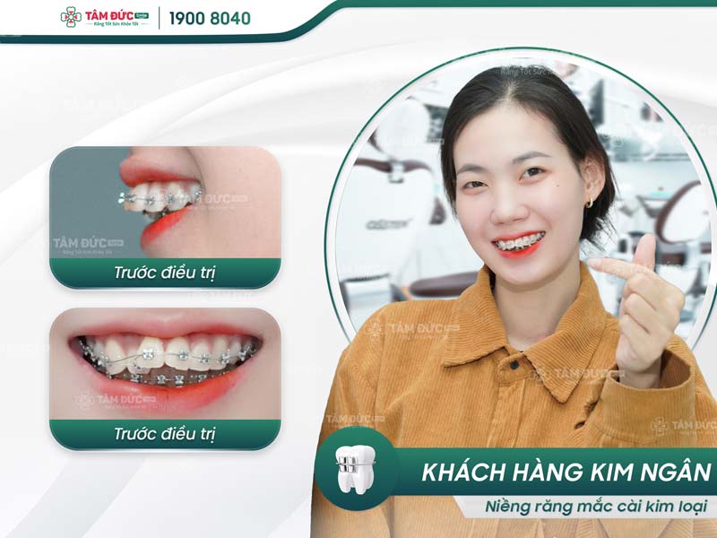 khách hàng niềng răng tại nha khoa Tâm Đức Smile Cần Thơ