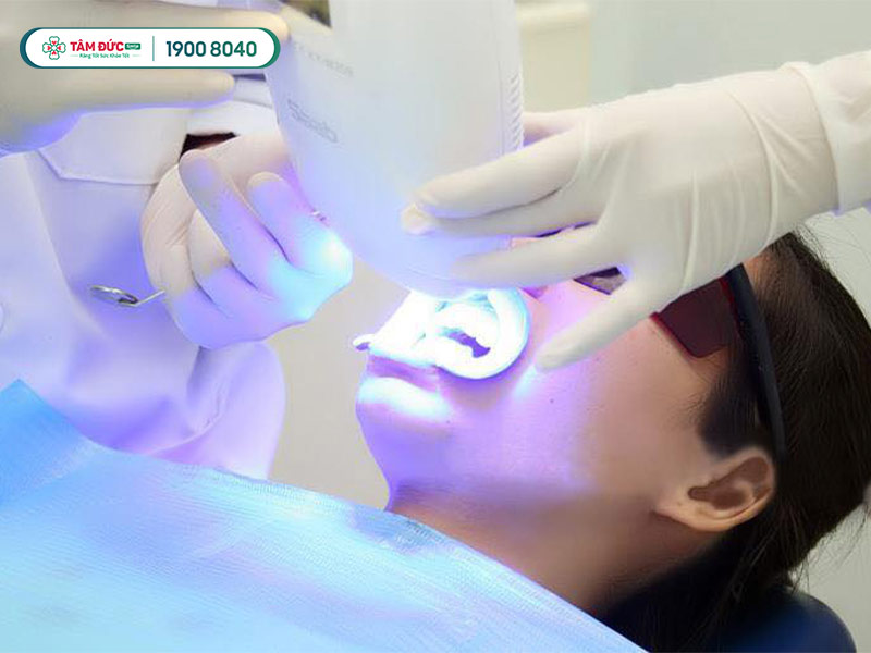 tẩy trắng răng laser giá bao nhiêu