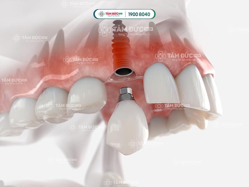 răng giả tạm thời được gắn lên trụ Implant