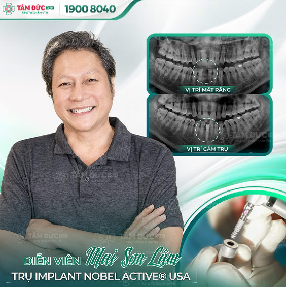 khách hàng trồng răng Implant tại nha khoa Tâm Đức Smile