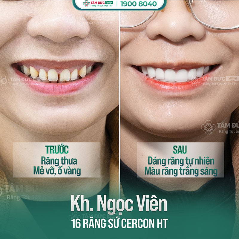 khách hàng bọc răng sứ tại nha khoa Tâm Đức Smile