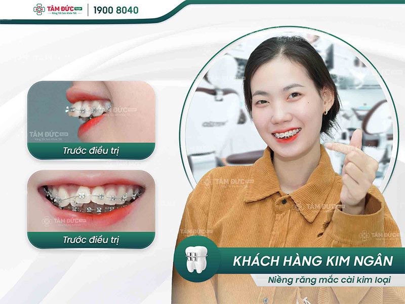 khách hàng niềng răng mắc cài tại nha khoa Tâm Đức Smile