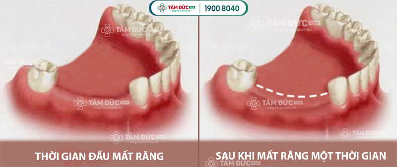 bị tiêu xương răng là gì