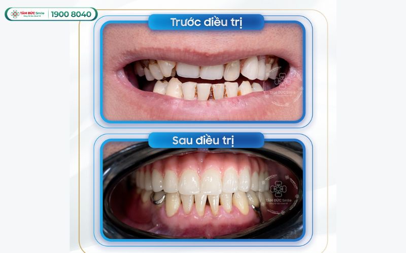 trong-rang-implant-4