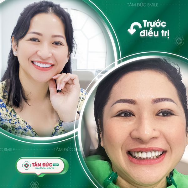 trám răng cửa thưa tại nha khoa Tâm Đức Smile