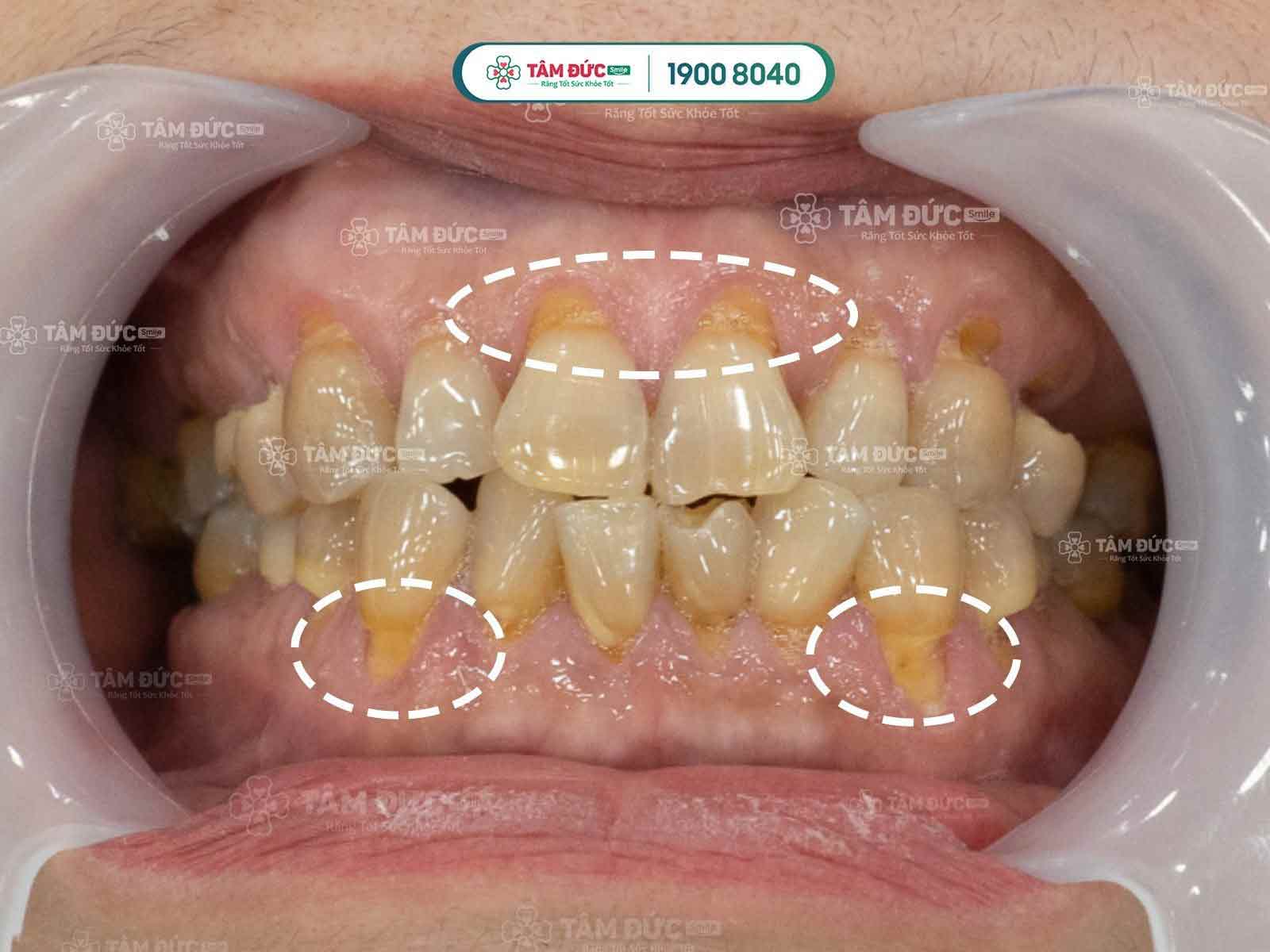 triệu chứng ê buốt răng do mòn cổ chân răng gây ra