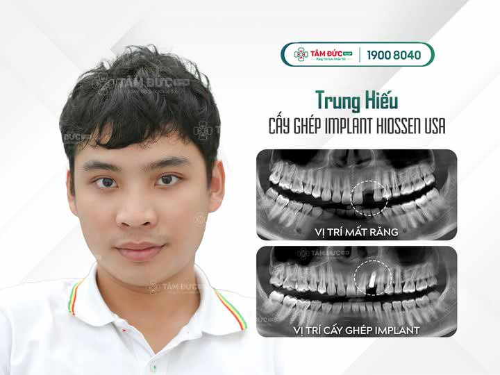 anh trung hiếu trồng lại răng hàm trên tại nha khoa Tâm Đức Smile