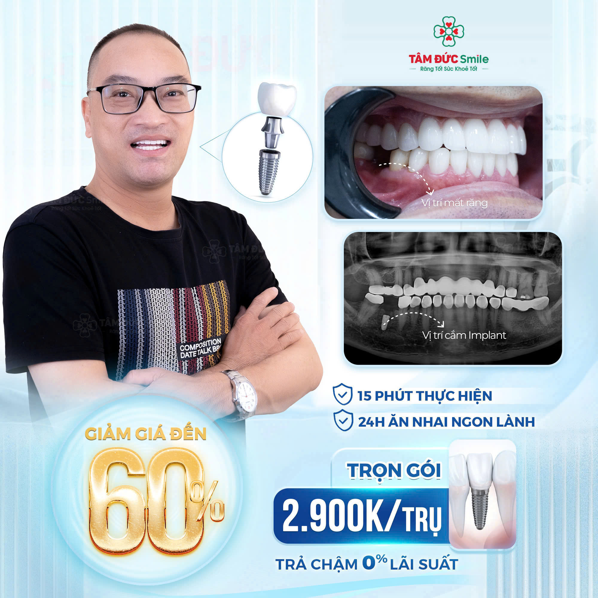 ƯU ĐÃI TRỒNG RĂNG IMPLANT TRỌN GÓI TỪ 2.900.000 Đ