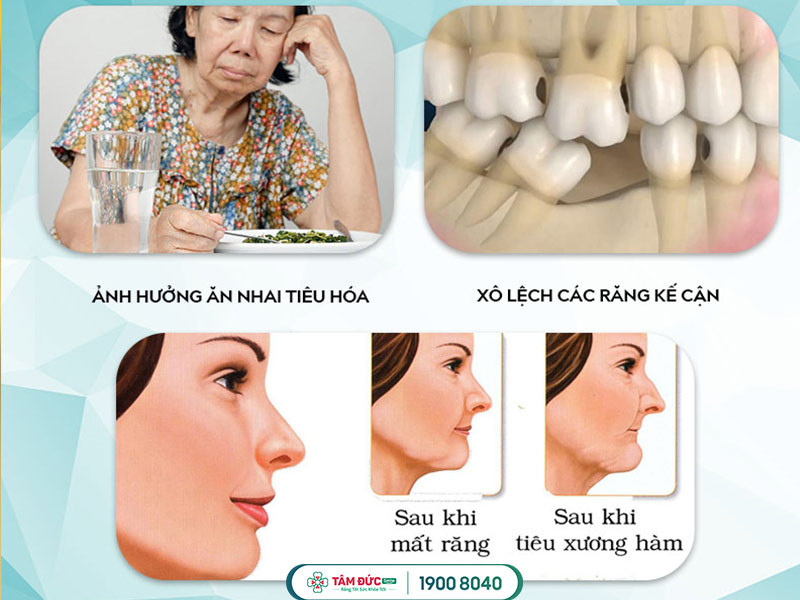 trồng răng cửa giá bao nhiêu