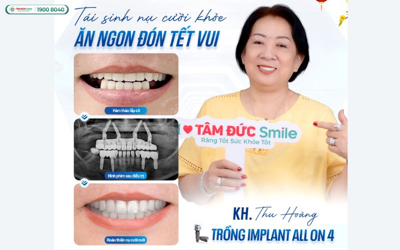 trong-rang-implant-all-on-4-1