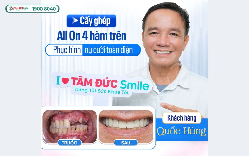 trong-rang-implant-all-on-4-2