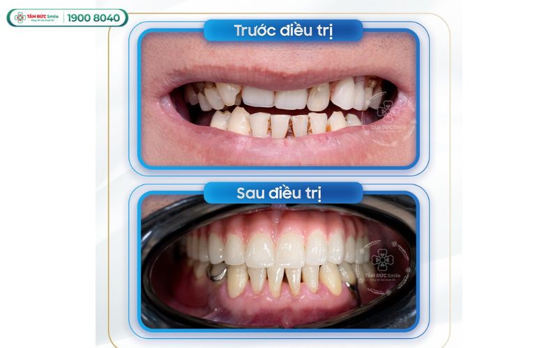 trong-rang-implant-all-on-4-5