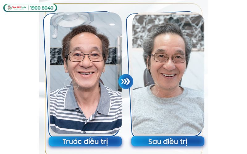 trong-rang-implant-all-on-4-7