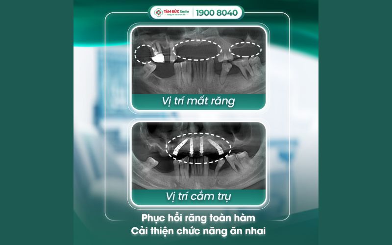 trong-rang-implant-all-on-4-8