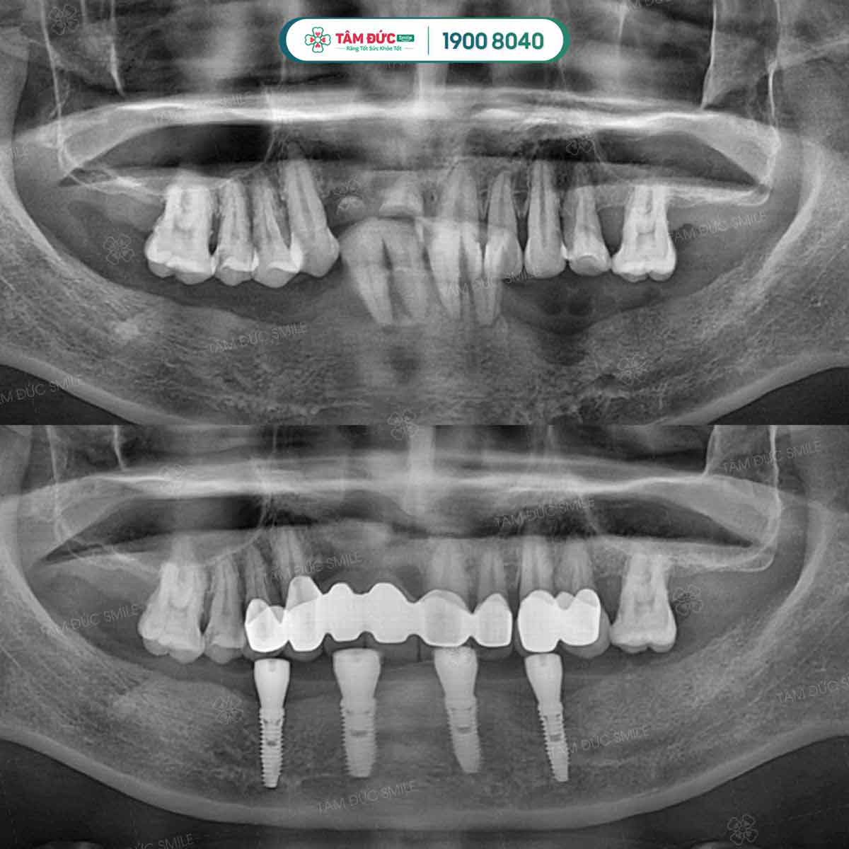 trồng răng implant all on 4 giá bao nhiêu tiền