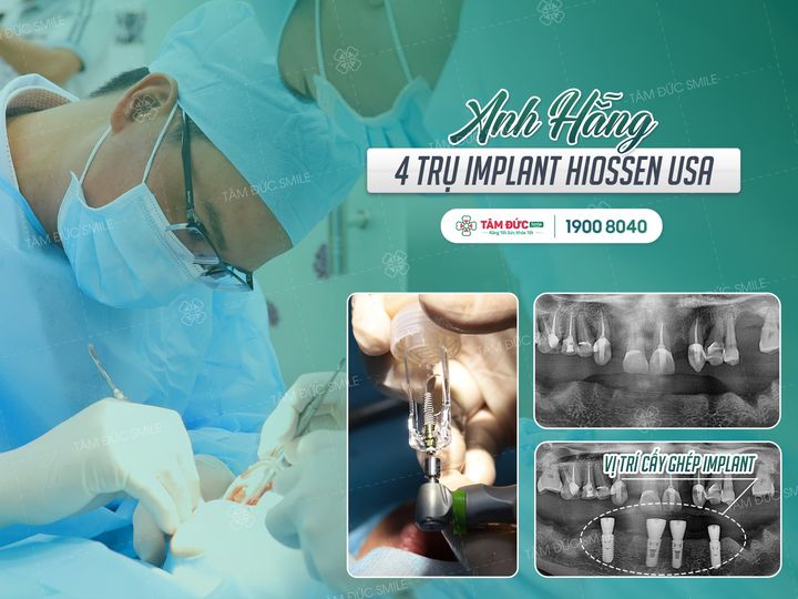 chi phí trồng răng implant all on 4 tuỳ vào dòng trụ mà quý khách lựa chọn