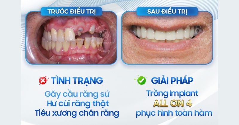 Trồng răng Implant All on 4: Phục hình toàn hàm bền đẹp tại Nha khoa Tâm Đức Smile