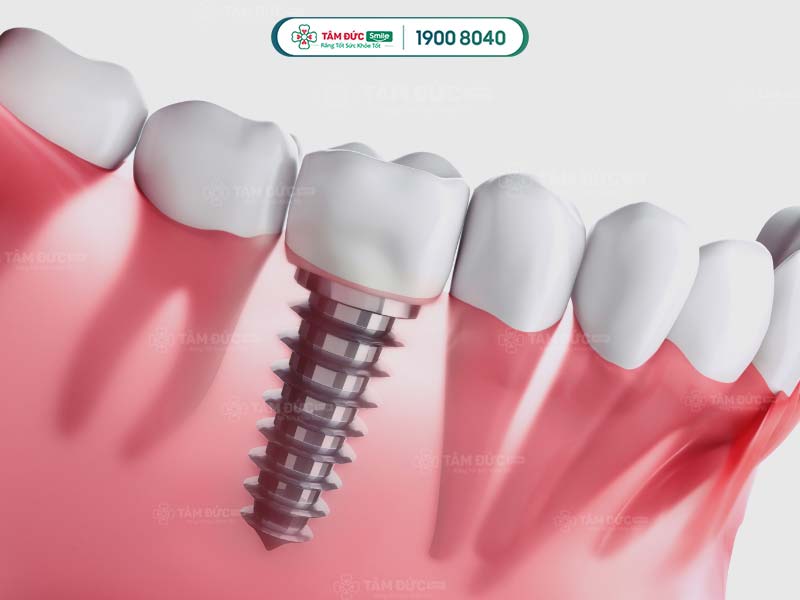 Trồng răng Implant sau 3-5 tiếng,Quý khách ăn được thức ăn mềm, lỏng