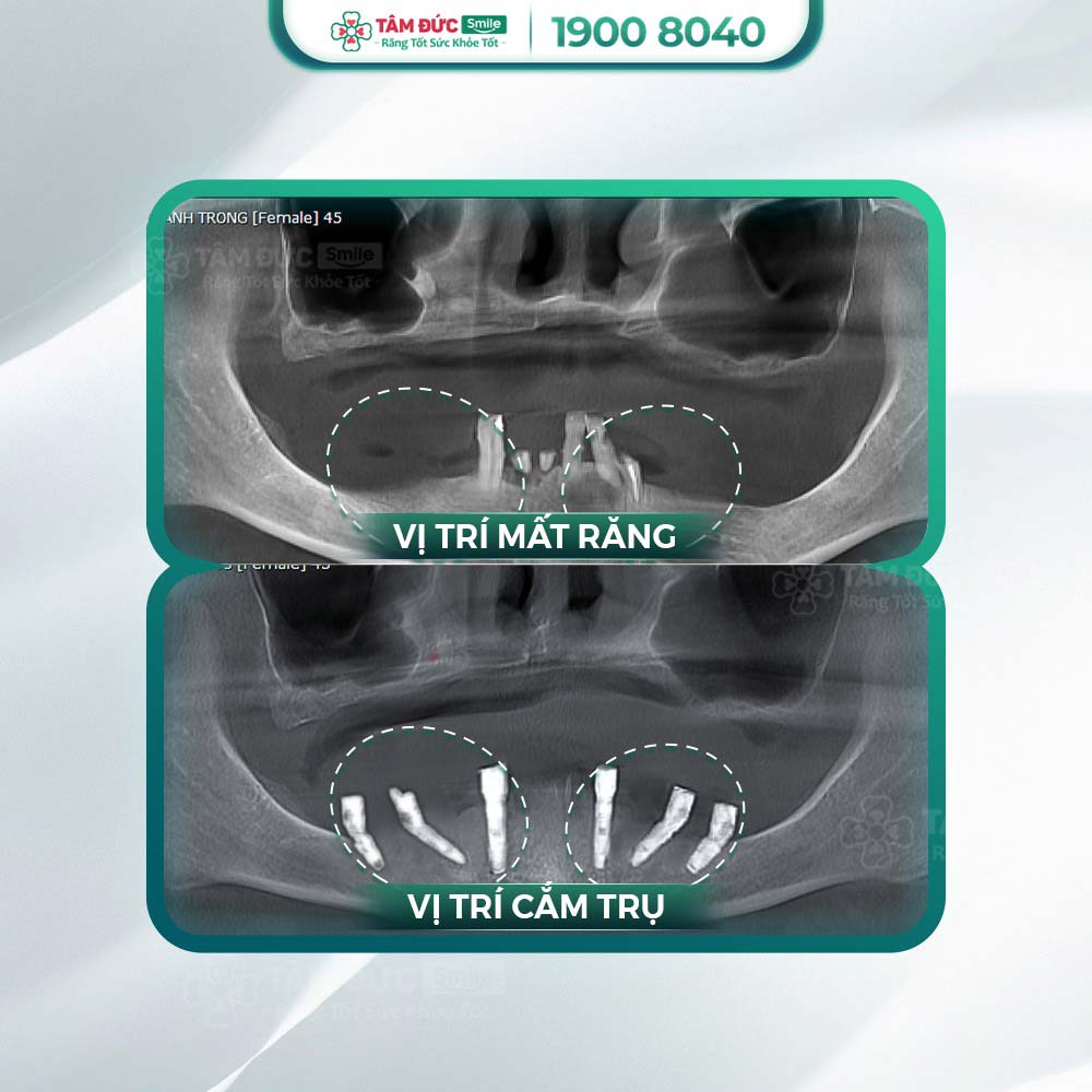 hình ảnh sau khi cấy ghép Implant