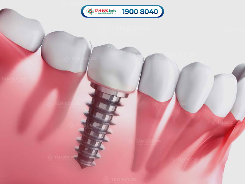 Trồng răng Implant sau 3-5 tiếng,Quý khách ăn được thức ăn mềm, lỏng