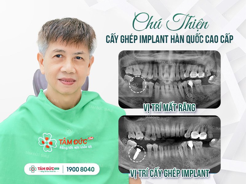 trồng răng implant có nguy hiểm không