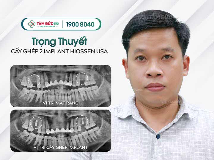 Anh Thuyết sau khi trồng răng Implant tại nha khoa Tâm Đức Smile