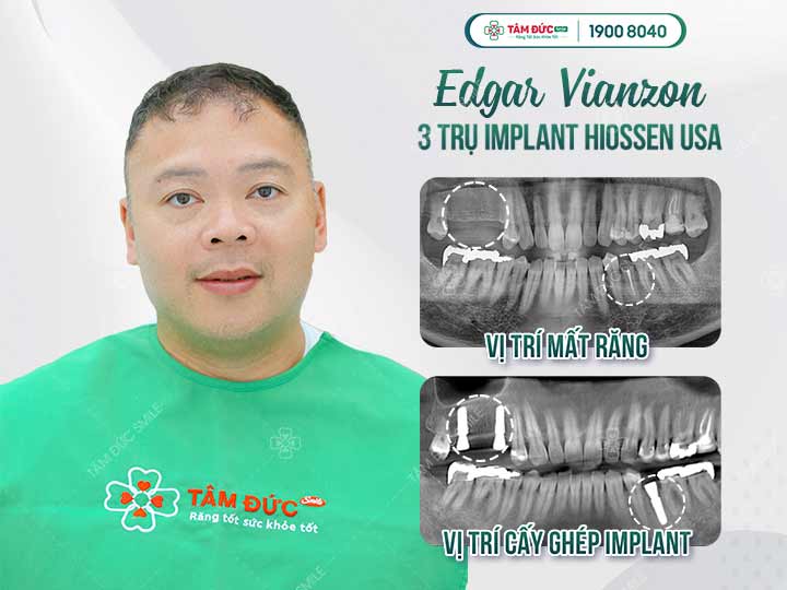 Anh Edgar Vianson sau khi trồng răng mới tại nha khoa Tâm Đức Smile