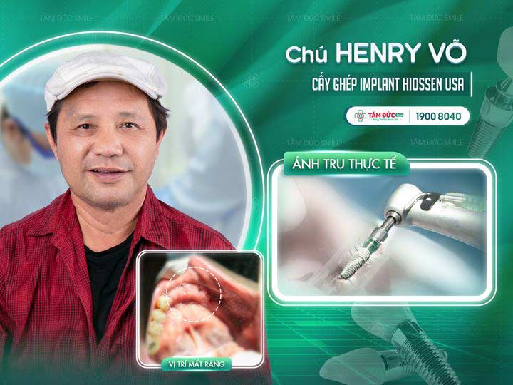 chú henry võ chọn trồng răng implant trụ hiossen của Mỹ