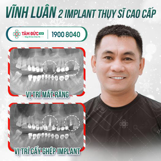 anh Vĩnh Luân trồng răng với trụ Implant thuỵ sĩ tại nha khoa Tâm Đức Smile