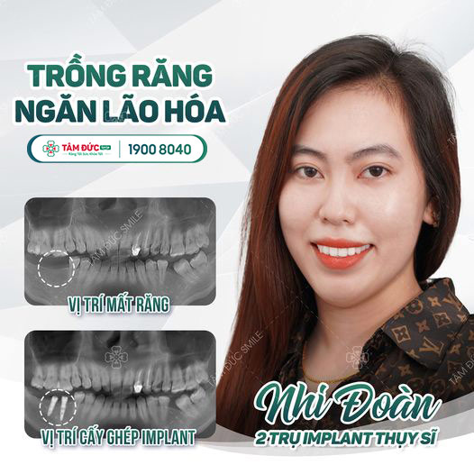 khách hàng trồng răng tại nha khoa Tâm Đức Smile