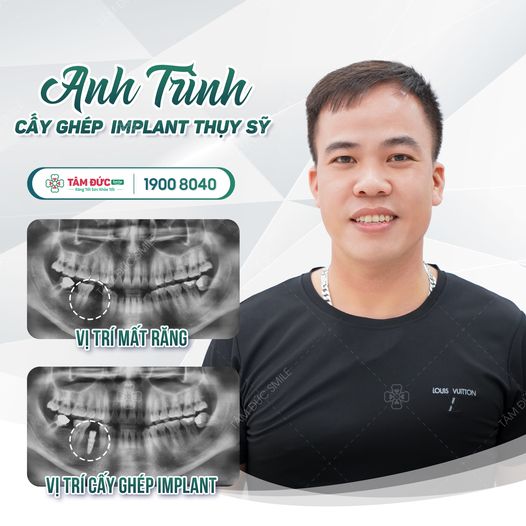 anh Trinh trồng răng implant Thuỵ Sĩ tại nha khoa Tâm Đức Smile