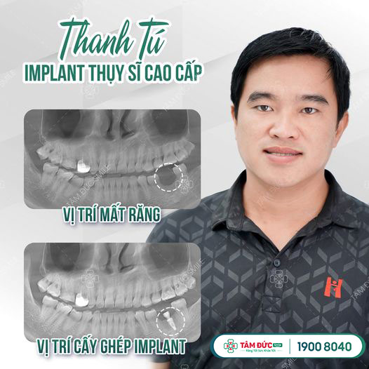 Anh Thanh Tú trồng răng trụ Implant Thuỵ Sĩ tại nha khoa Tâm Đức Smile