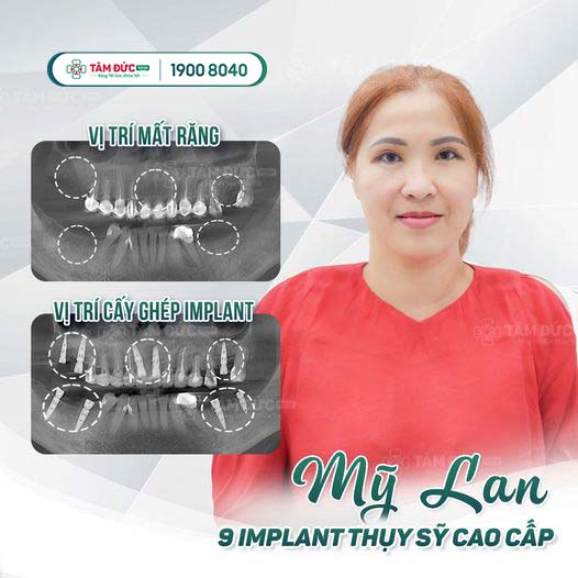 khách hàng trồng răng với trụ implant thuỵ sĩ