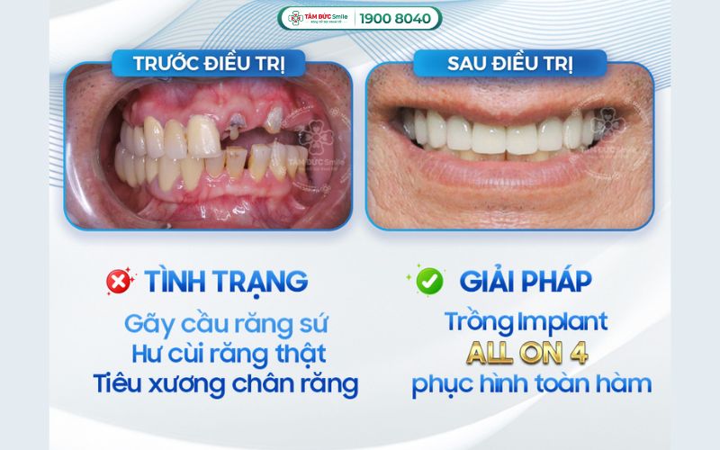trong-rang-implant-1
