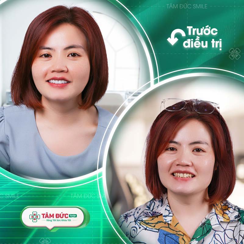 Hình ảnh khách hàng bọc răng sứ tại Tâm Đức Smile