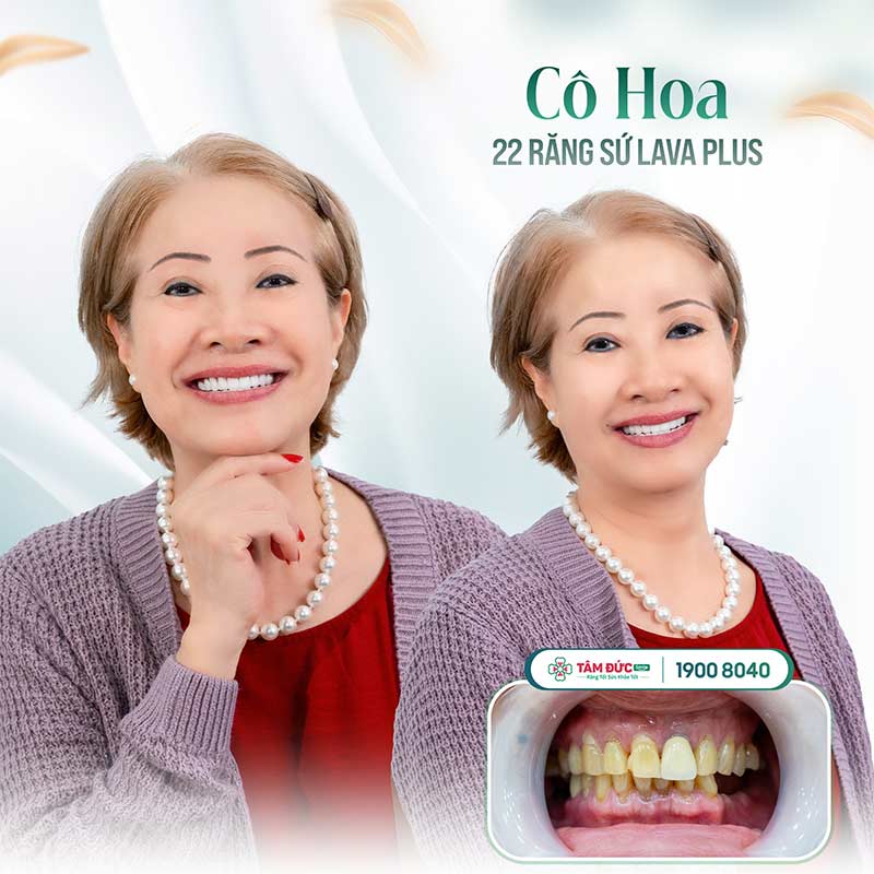 khách hàng khắc phục tụt lợi hở chân răng tại nha khoa Tâm Đức Smile