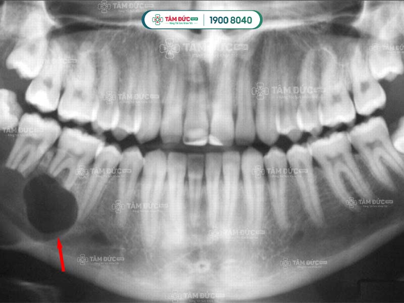 tuỷ răng bị hoại tử tuỷ kéo dài làm hình thành nang răng