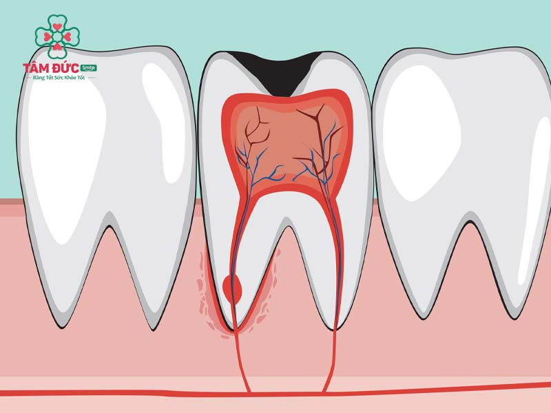 tuỷ răng có tác dụng gì