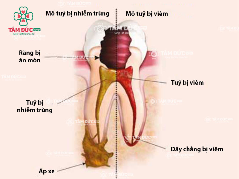 tuỷ răng bị viêm và tuỷ răng bị nhiễm trùng