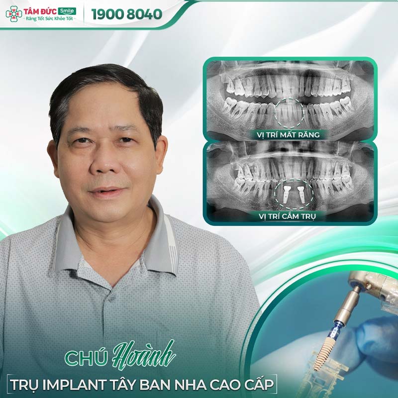 khách hàng trồng răng implant tại nha khoa Tâm Đức Smile