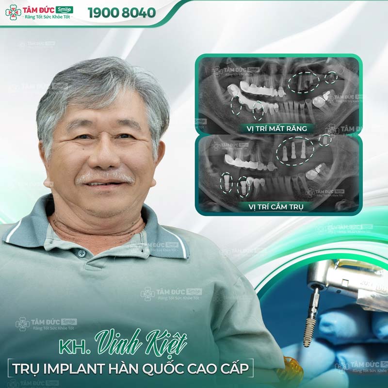 khách hàng trồng răng implant tại nha khoa Tâm Đức Smile