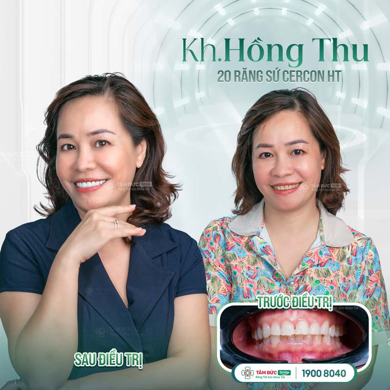 Bọc răng sứ tại Nha khoa Tâm Đức Smile để điều trị vàng răng