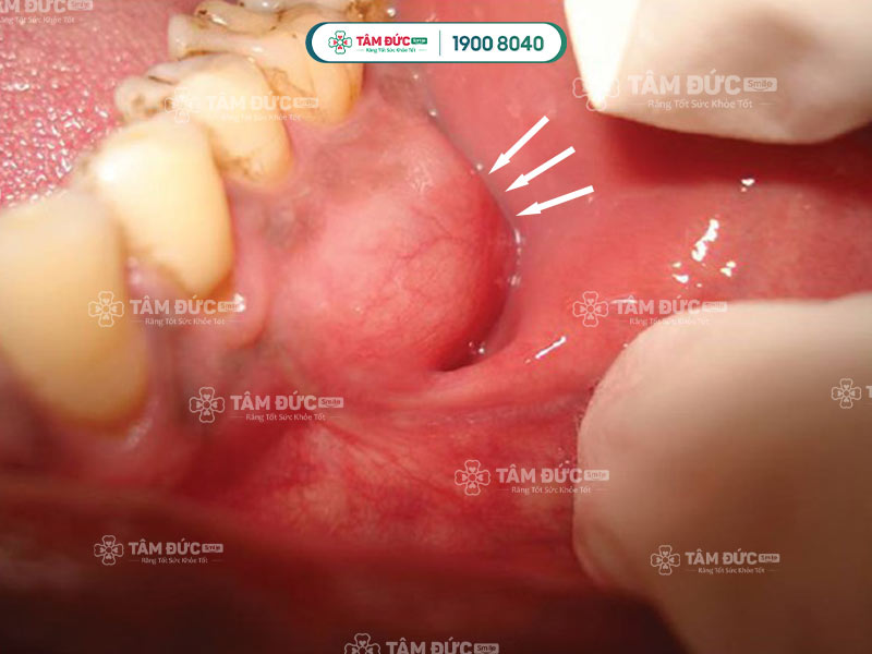 viêm lợi có mủ do nhiều nguyên nhân